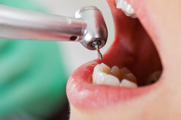 Best Chipped Tooth Repair Near Me  in Duncannon, PA